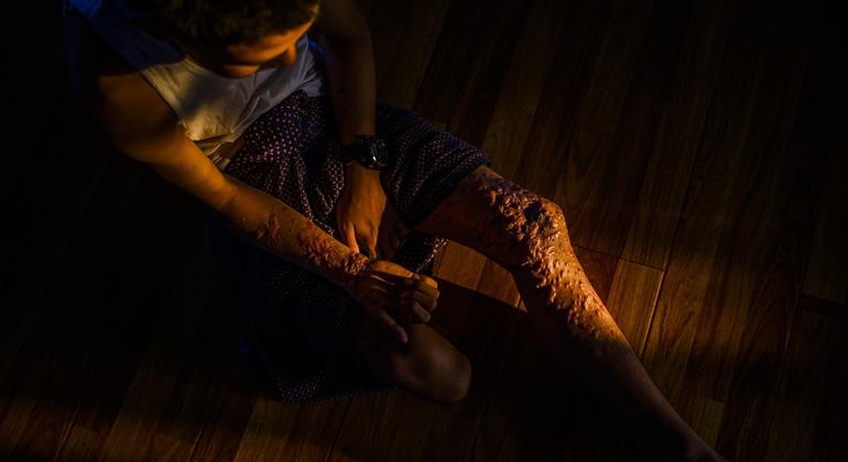 Children and amputees bear brunt of Myanmar’s deadly landmine epidemic