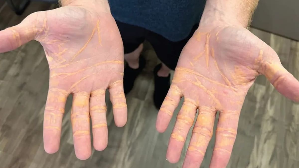 Man Ate Only Cheese, Butter, Hamburgers On Carnivore Diet - Develops Oozy Yellow Nodules On Body