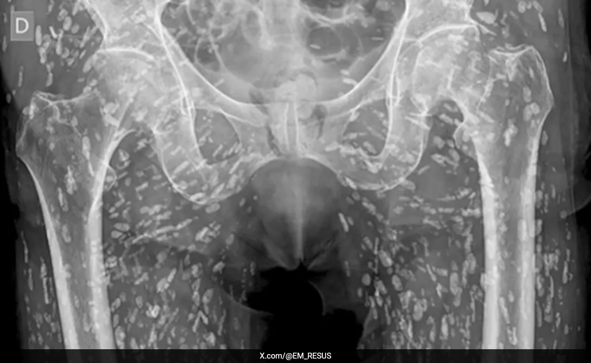 Shocking X-ray Reveals Human Body Infested With Tapeworm Larvae
