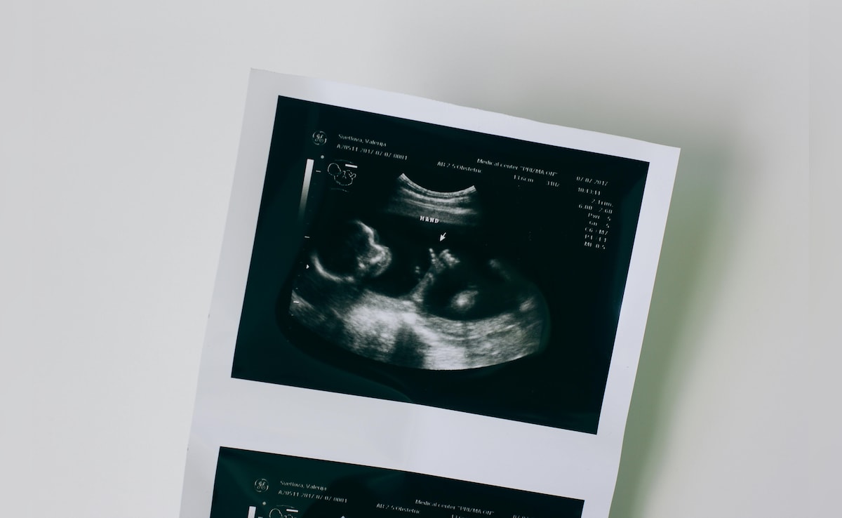 Baby Successfully Treated For Deadly Motor Neuron Diseases While Still In Womb
