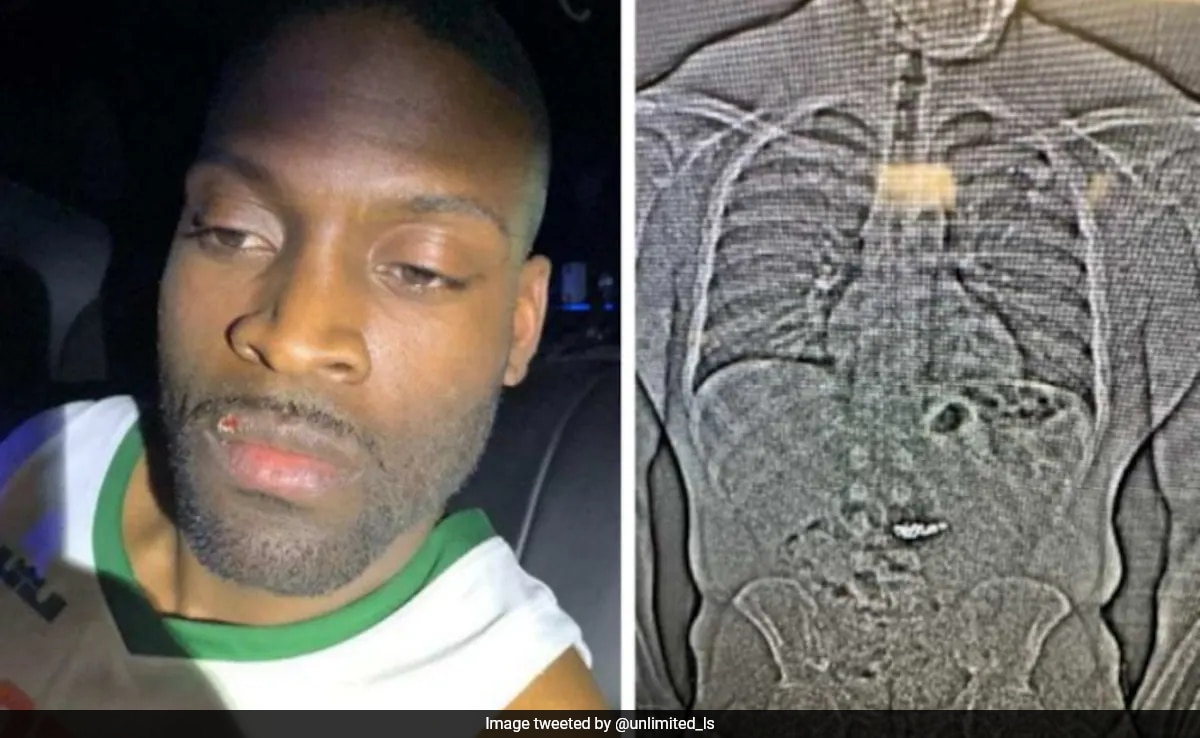 US Man Swallows Diamond Worth Rs 6.7 Crore, Asks If He'll Be Charged For "What's In My Stomach"